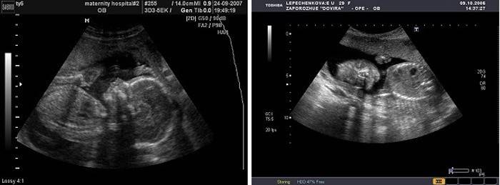 Ultra-sonografia do feto com 20 semanas de gestação
