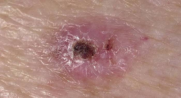 Cara piel carcinoma basocelular