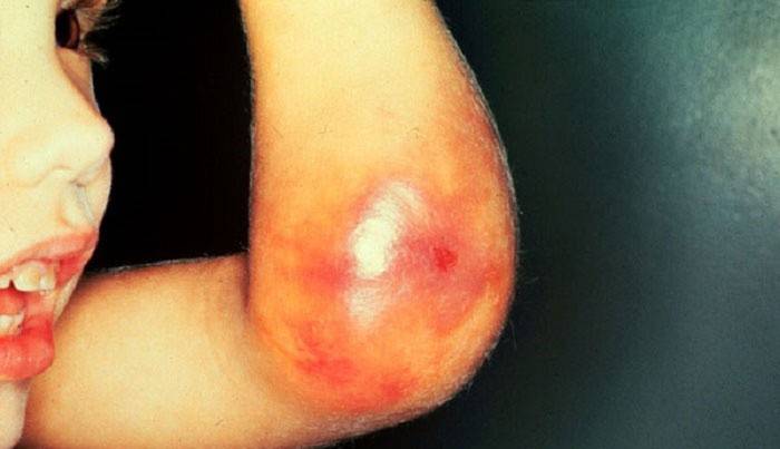 Hemofilia em uma criança é acompanhada por hematomas e sangramento