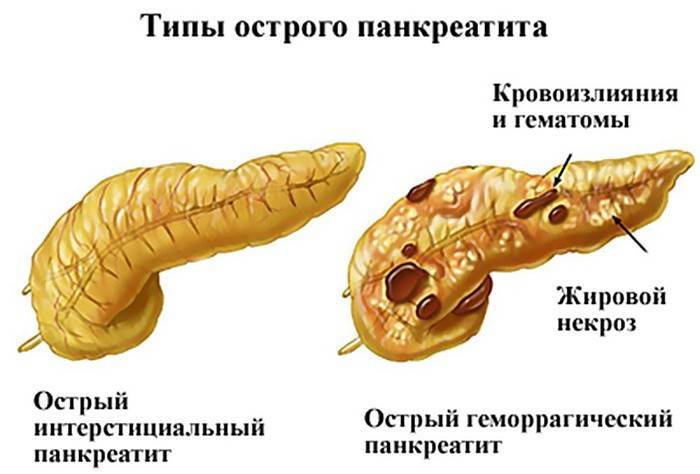 Tipos de pancreatite aguda