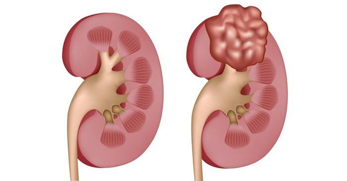 Quiste renal