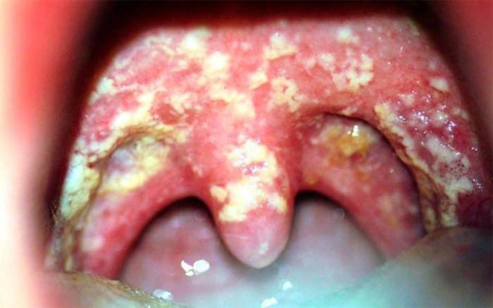 Inflamação folicular