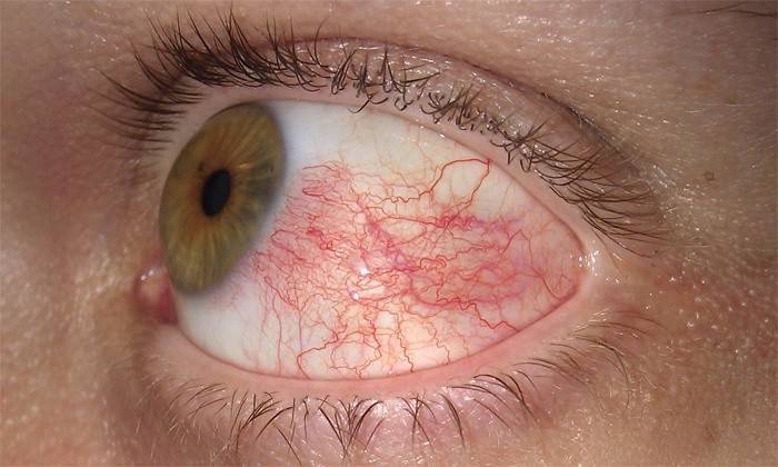 Doença ocular
