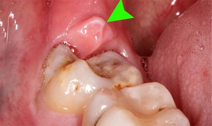 Inflamación de las encías alrededor de la figura ocho