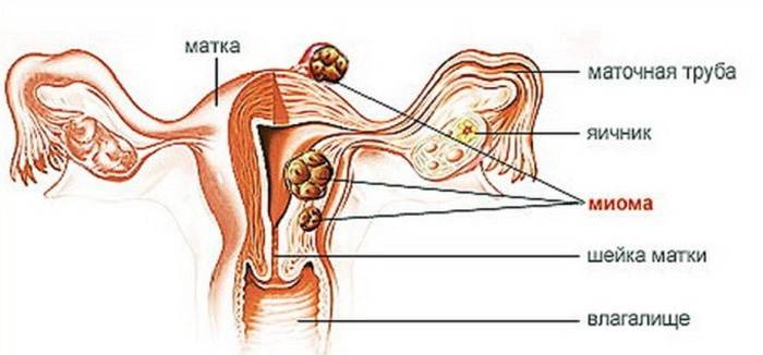 Coágulos sanguíneos são comuns com mioma