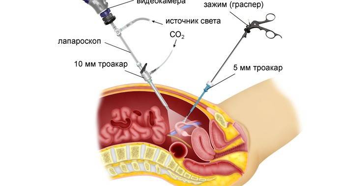 Laparoscopia