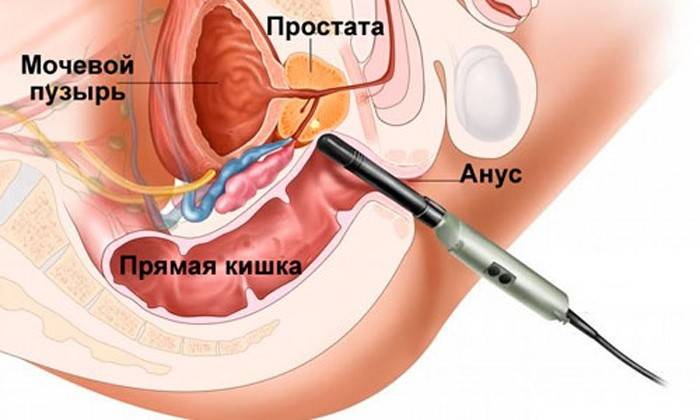 Ako sa vstrekuje masér prostaty?