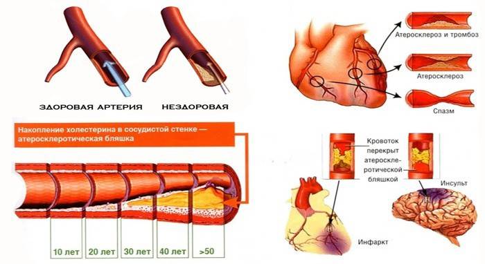 Hromadenie cholesterolu v cievach