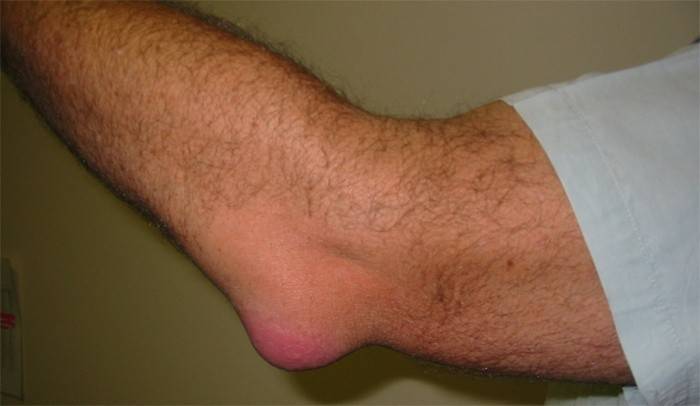Bursite ulnar crônica em homens