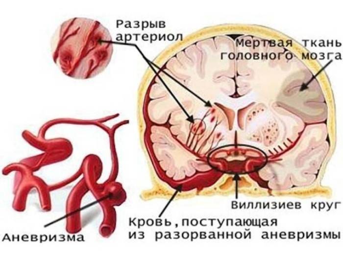 El efecto del alcohol en los vasos sanguíneos del cerebro.
