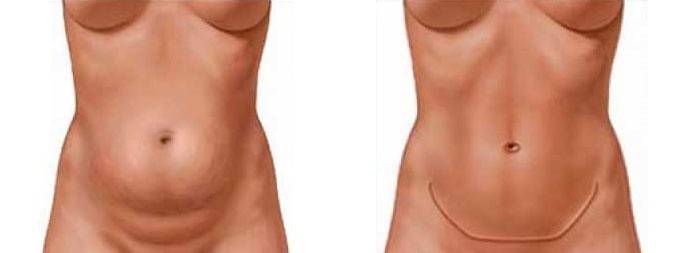 Barriga antes e depois do exercício
