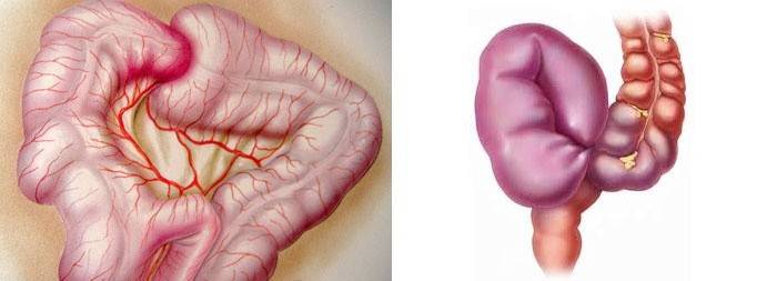 Inversão intestinal