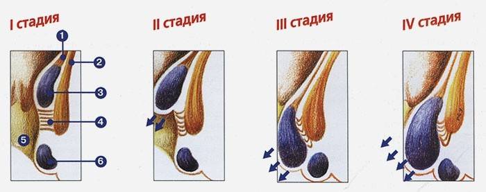 Etapy hemoroidov