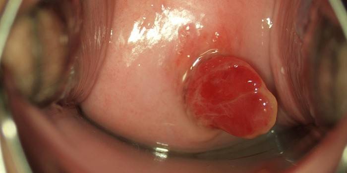 Polyp v maternici