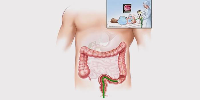 Fibrocolonoscopia para o diagnóstico de doenças do reto