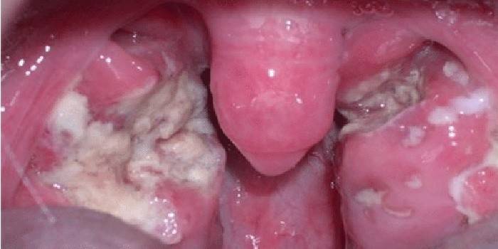 Angina lacunar