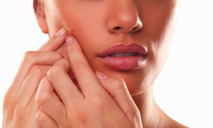 Acne no rosto em adultos