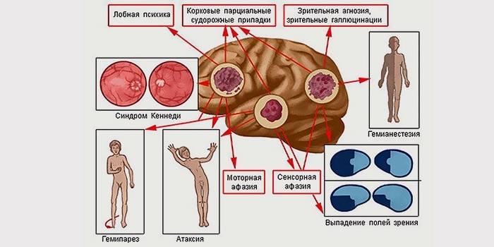 Sinais de glioblastoma