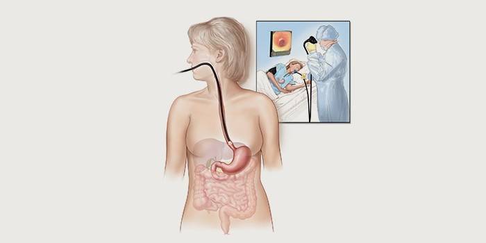 Diagnóstico de reflujo duodenogástrico - gastroscopia
