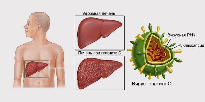 Fígado de hepatite C