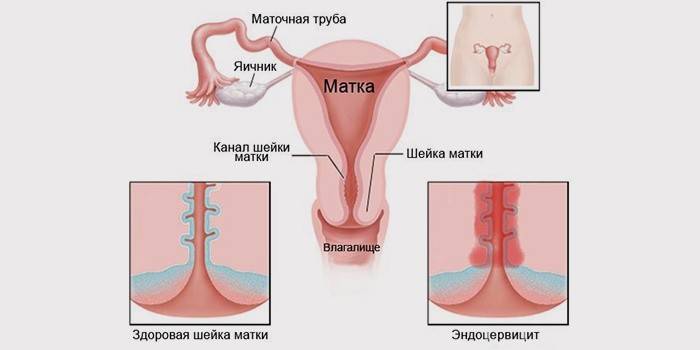 Endocervicitída - dôsledok prolapsu maternice