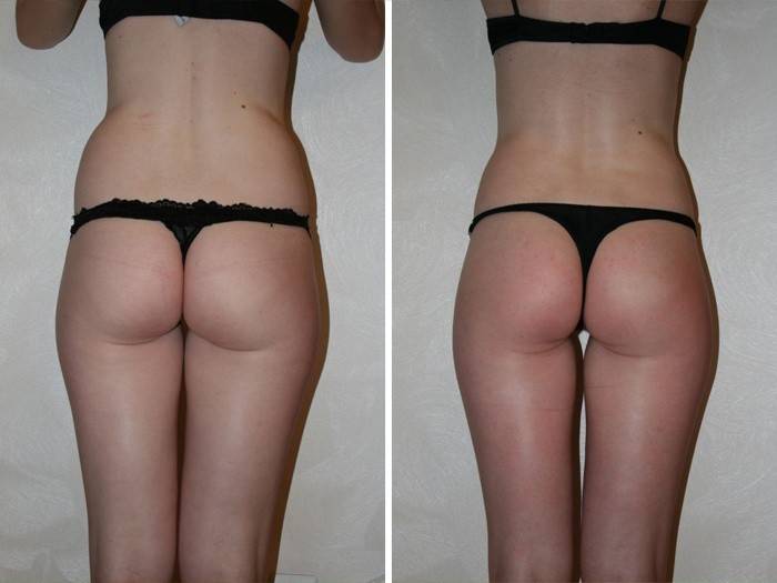 Fotos antes e depois de procedimentos de massagem de drenagem linfática
