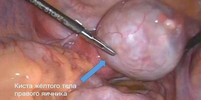 Terapia cirúrgica para cisto de corpo lúteo ovariano