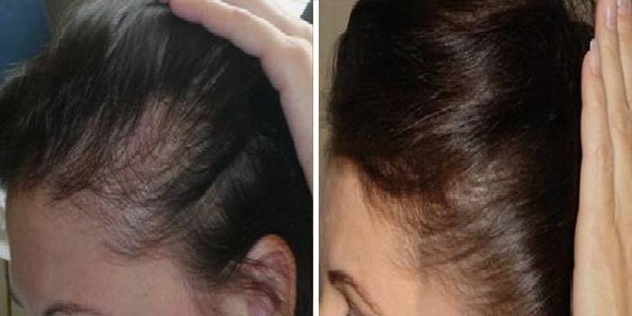 Cabelo antes e depois de usar darsonval