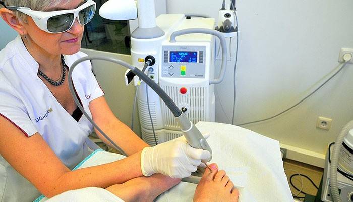 Liečba laserovou onychokryptózou