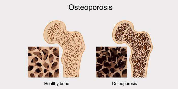 Kostná osteoporóza