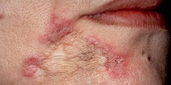 Sinal, adulto, pele, tuberculose