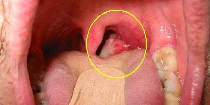 Síntomas del cáncer de garganta en la etapa inicial.