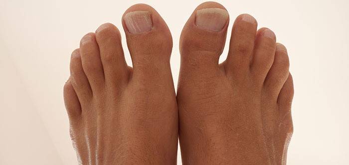 bursitis