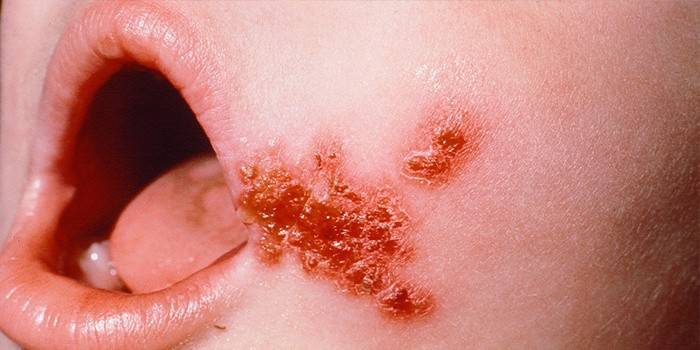 Oznaki Staphylococcus aureus