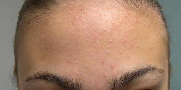 Acne na testa de uma menina