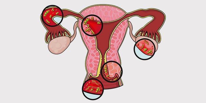 Inflamación genital femenina