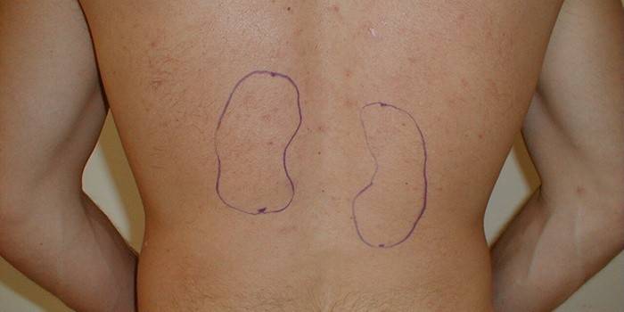 Nefroptosis del riñón derecho
