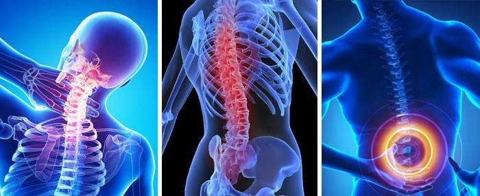 Druhy osteochondrózy v lokalizácii