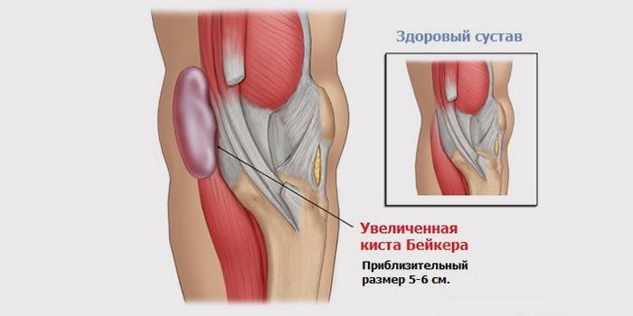Quiste de Baker de la articulación de la rodilla