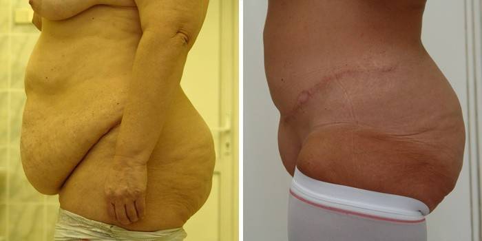 Resultado de la abdominoplastia