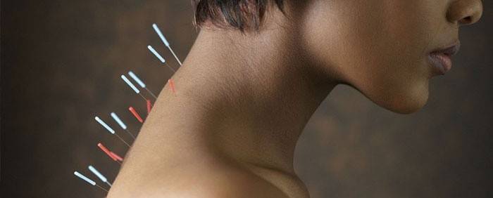 Acupuntura para la osteocondrosis de la columna cervical.