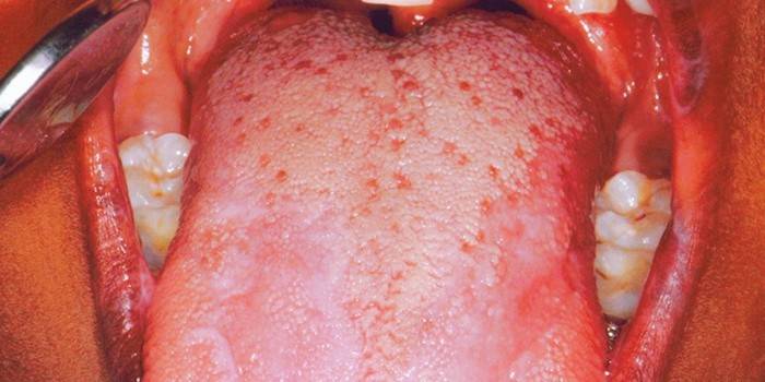 Lichen planus v ústnej dutine
