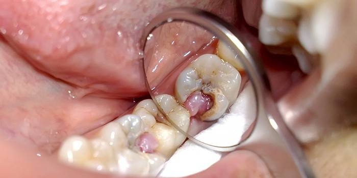 Pulpite, que requer a remoção do nervo dentário