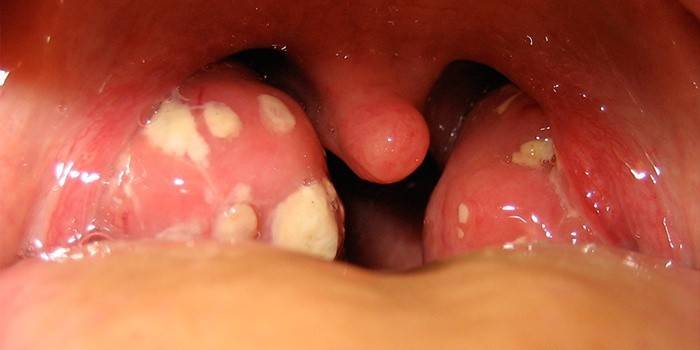 Pus na garganta com angina