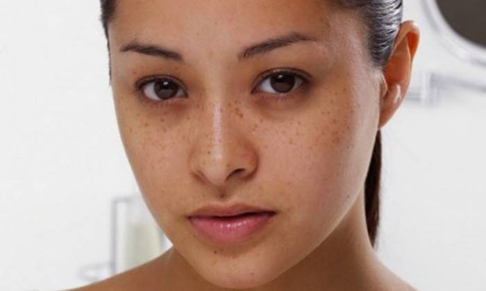 Círculos escuros sob os olhos da menina