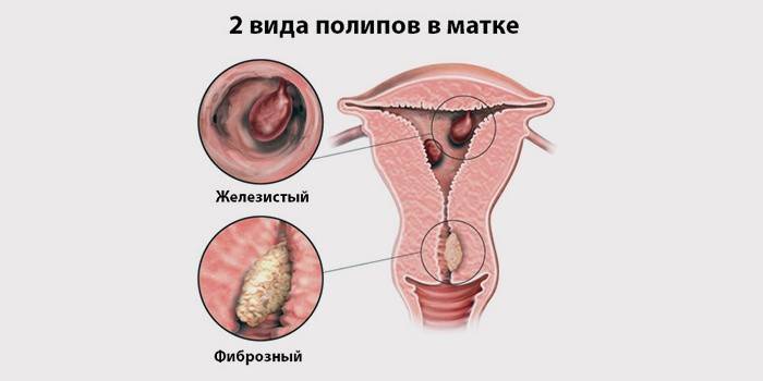 Druhy polypov v maternici
