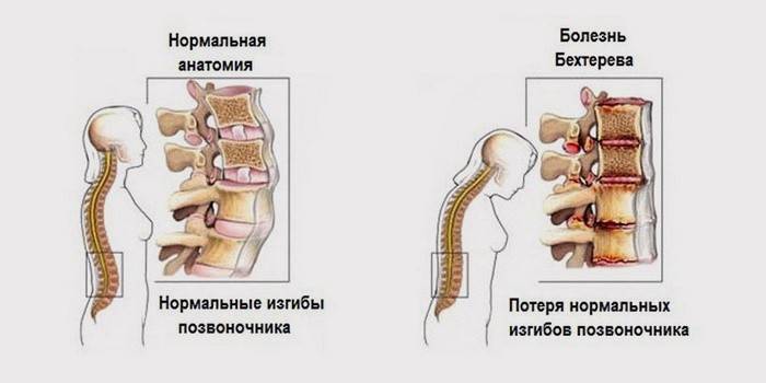 Comparación de la columna vertebral normal y enferma
