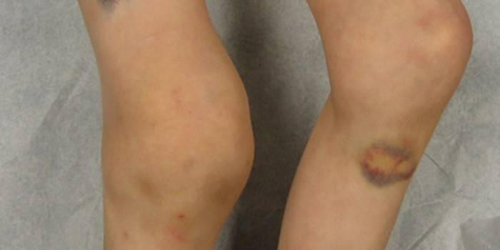 Consequências da doença de Schlatter em uma criança