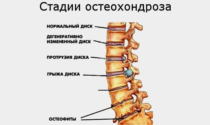 Etapy osteochondrózy
