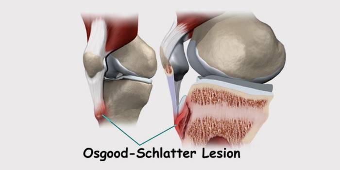 Como é a doença de Osgood Schlatter?